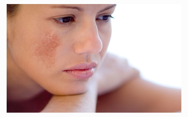 Mẹo làm đẹp: 4 cách trị nám da mặt bằng phương pháp dân gian hiệu quả
