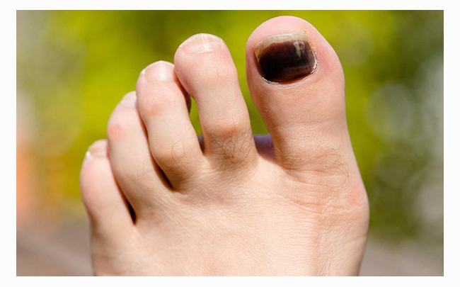 Cẩm nang sức khỏe: Móng chân bị đen là bệnh gì?